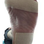 Moleskin applied for march